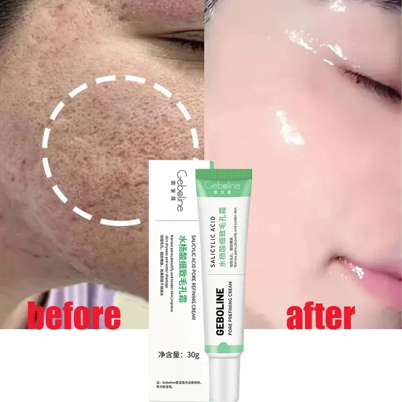 Salicylic Acid Pore Shrinking  - Skincare Salicylic Acid บทวิจารณ์และราคา