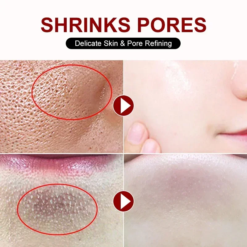 Salicylic Acid Pore Shrinking  - Skincare Salicylic Acid บทวิจารณ์และราคา